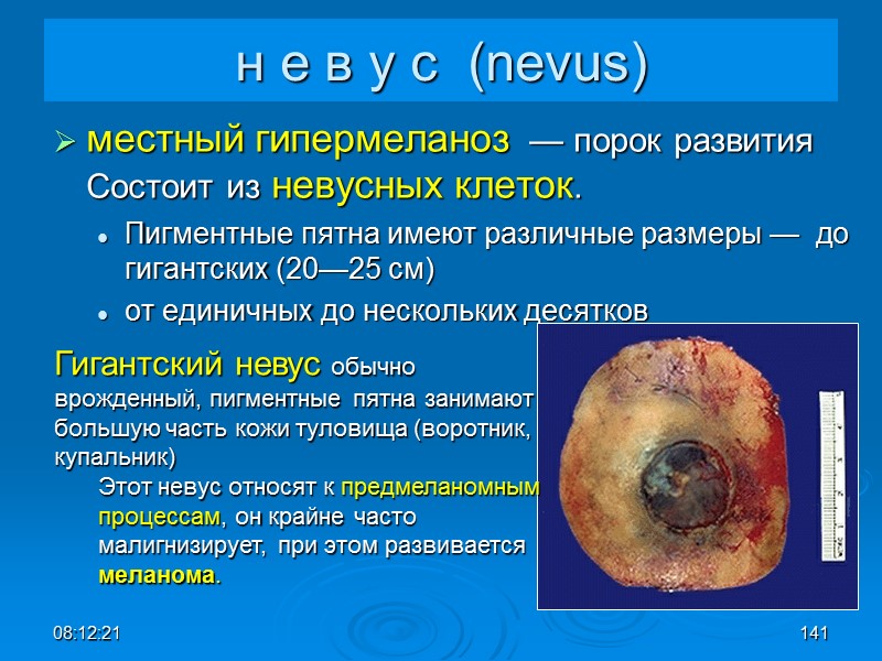 08:12:02 141 н е в у с  (nevus) местный гипермеланоз  — порок
